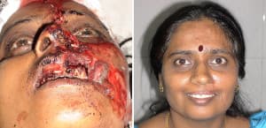 nose job cost