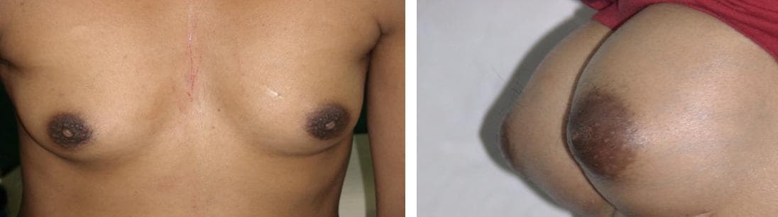 nose job cost