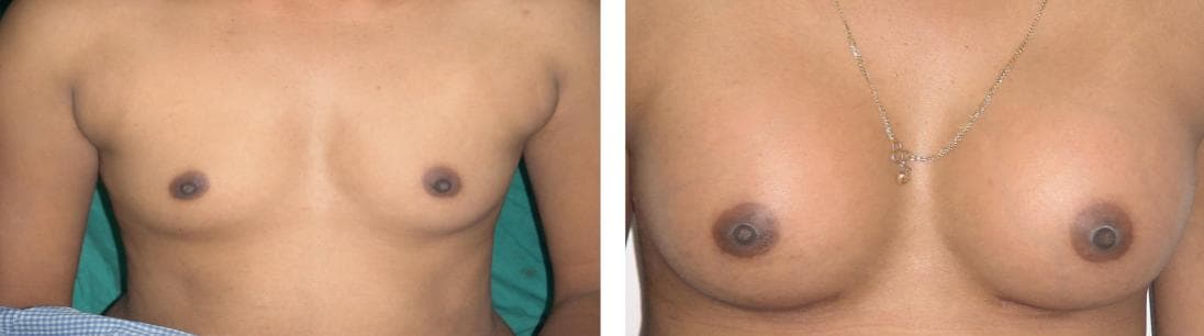 nose job cost