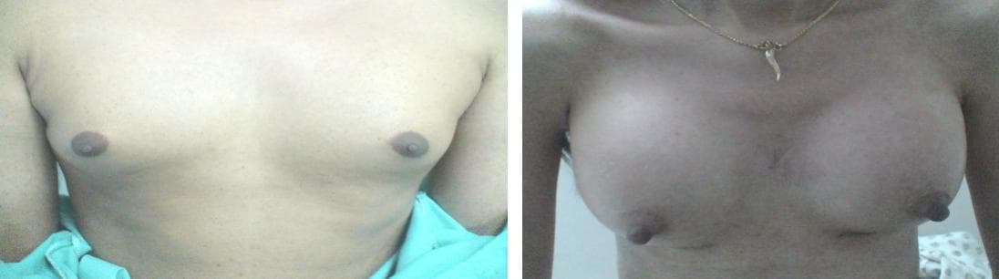nose job cost