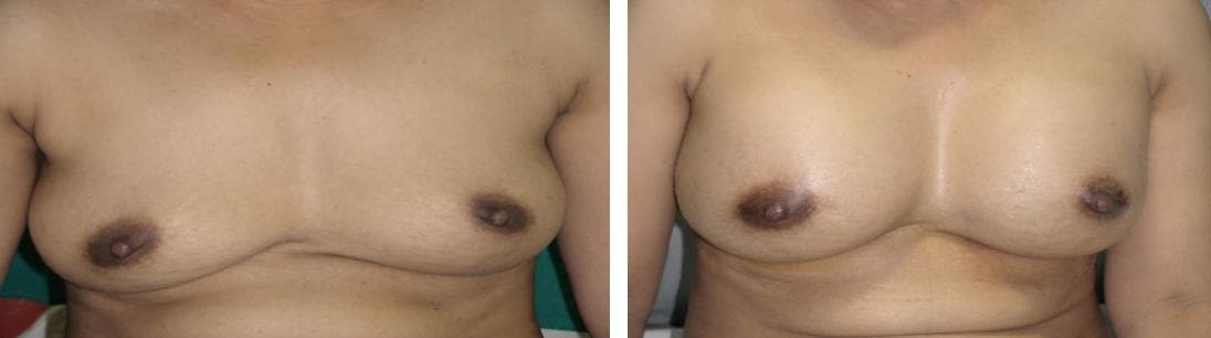 nose job cost