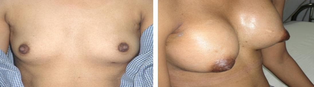 nose job cost