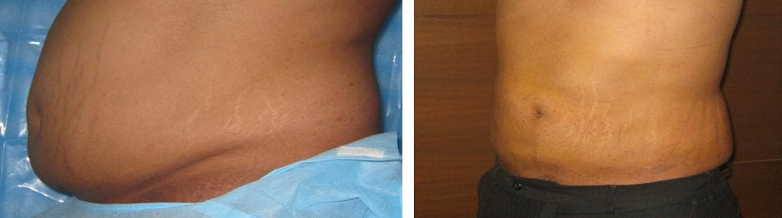nose job cost