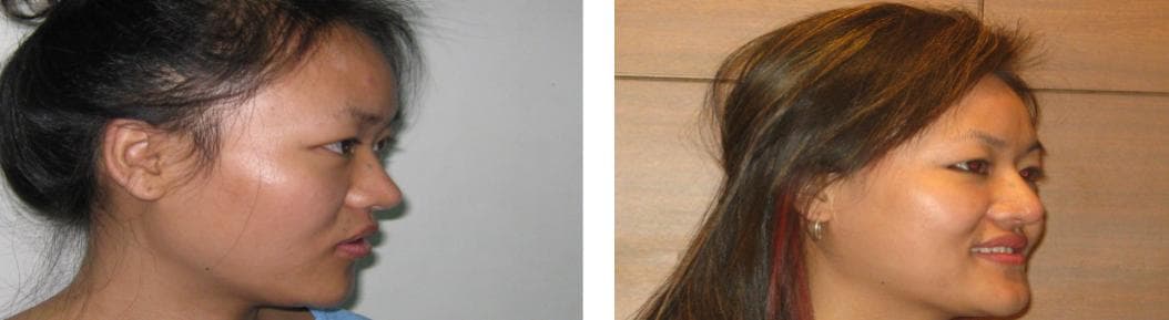 nose job cost