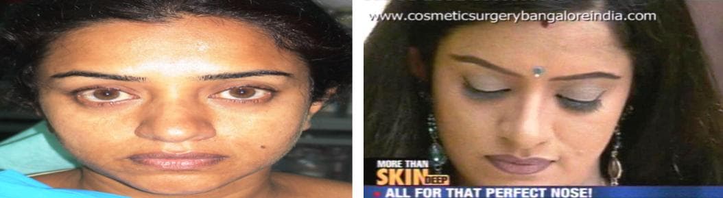 nose job cost