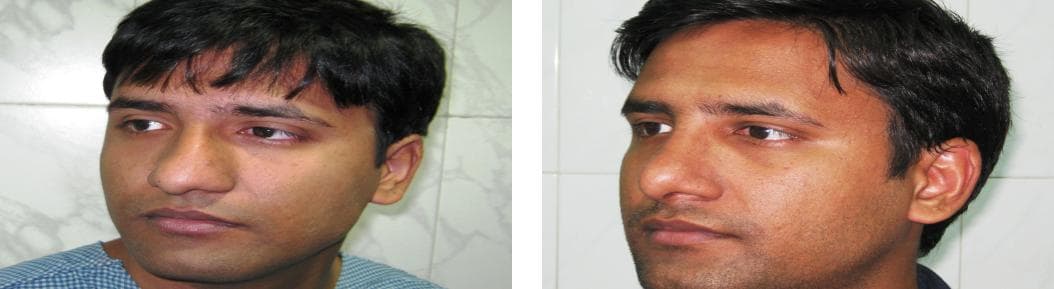 nose job cost