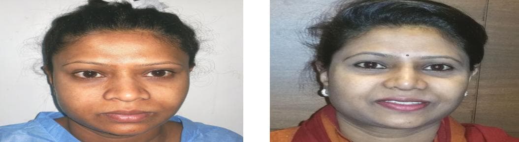nose job cost