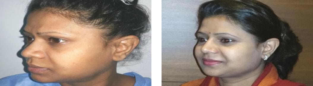 nose job cost