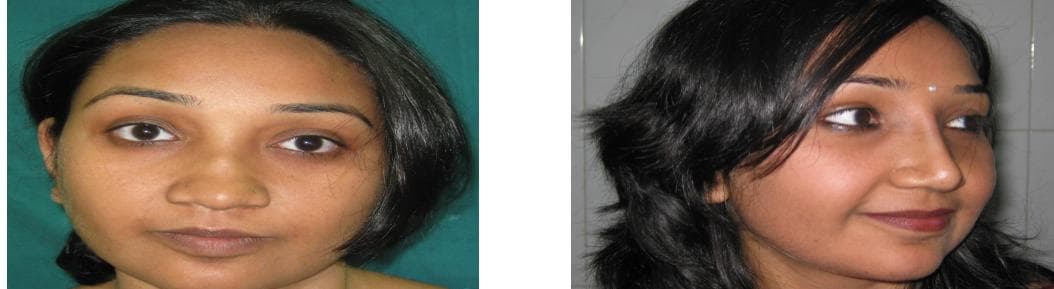 nose job cost