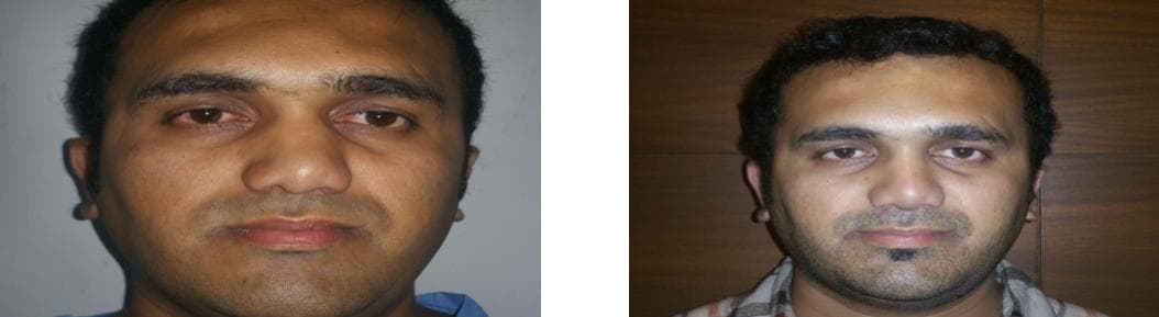 nose job cost