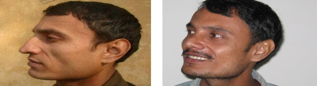 nose job cost