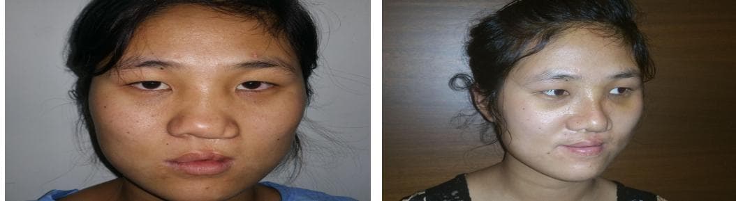 nose job cost