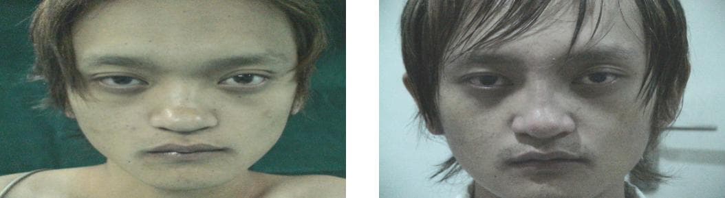 nose job cost