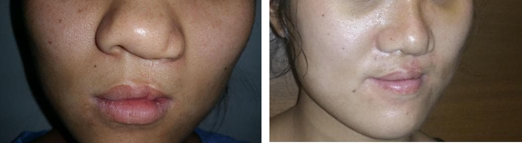 nose job cost