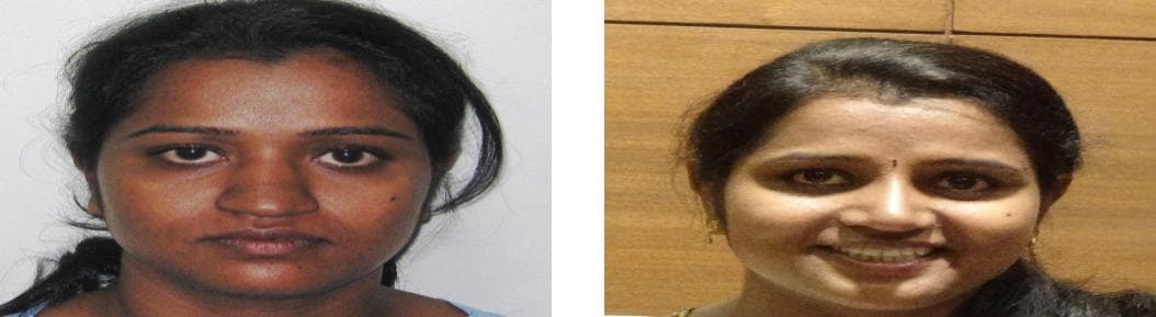 nose job cost