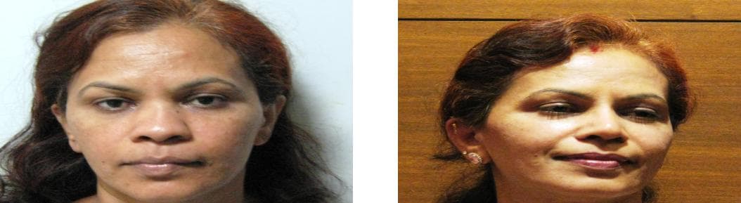 nose job cost
