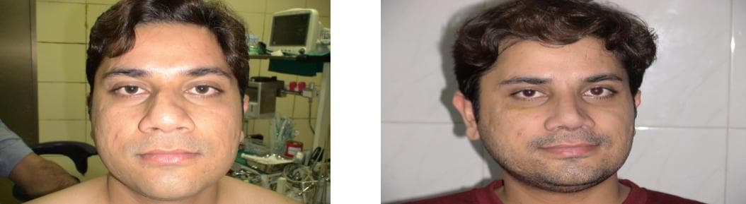 nose job cost