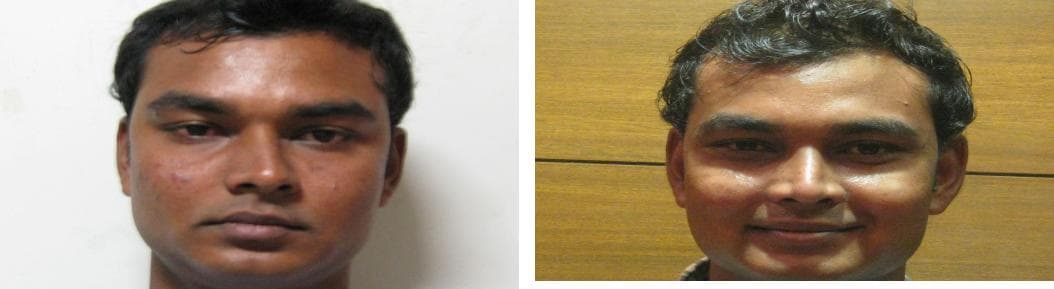 nose job cost