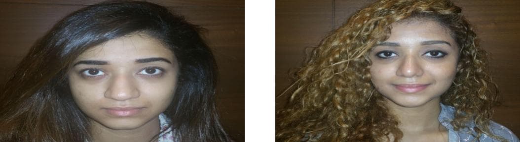 nose job cost