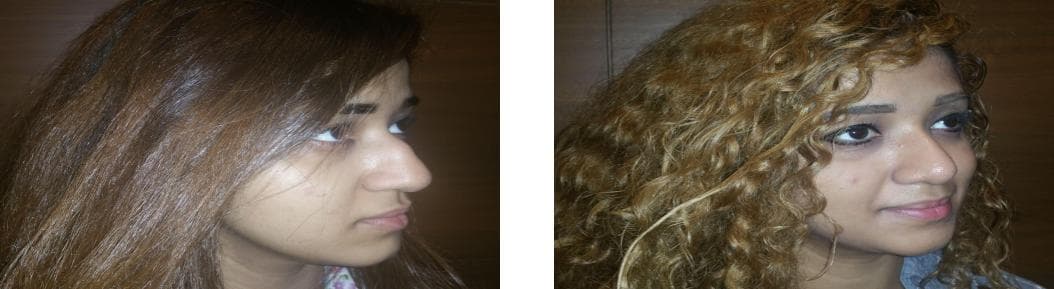 nose job cost