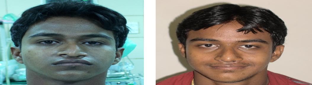 nose job cost
