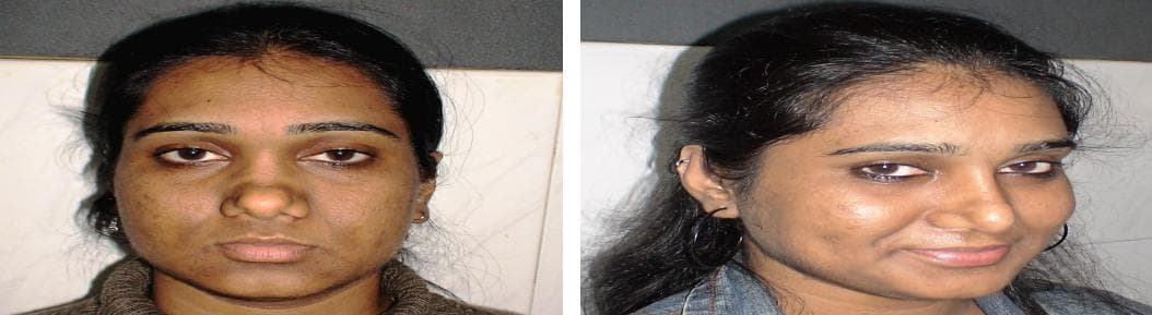 nose job cost