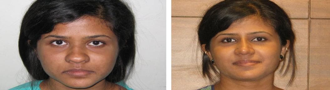 nose job cost