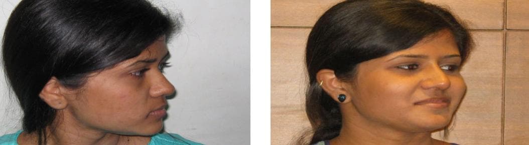 nose job cost