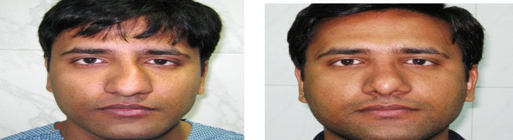 nose job cost