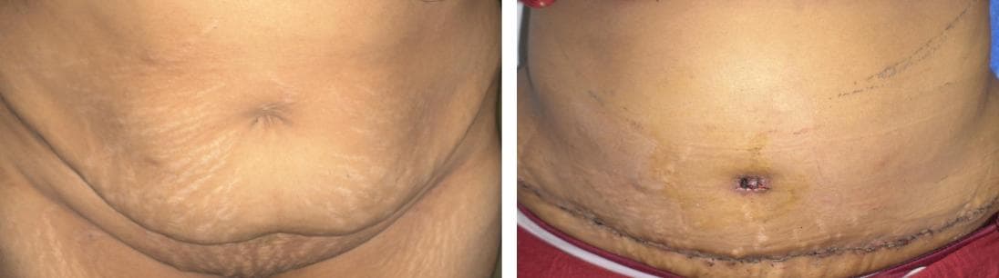 nose job cost