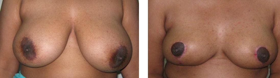 nose job cost