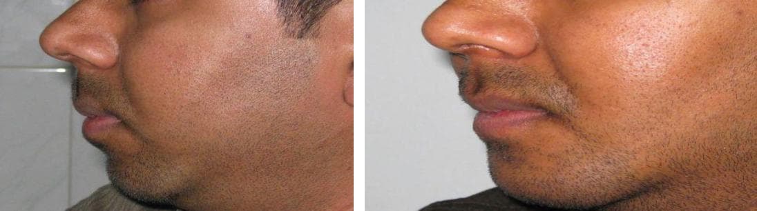 nose job cost