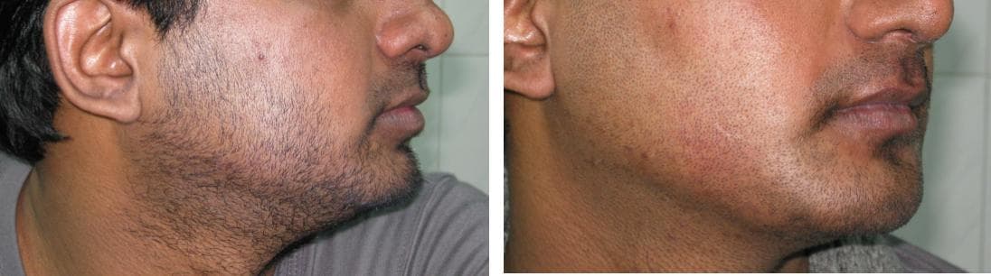nose job cost