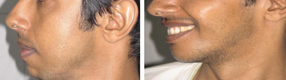 nose job cost