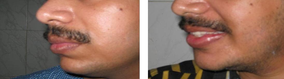 nose job cost