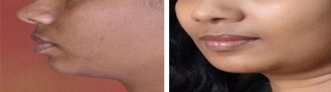 nose job cost
