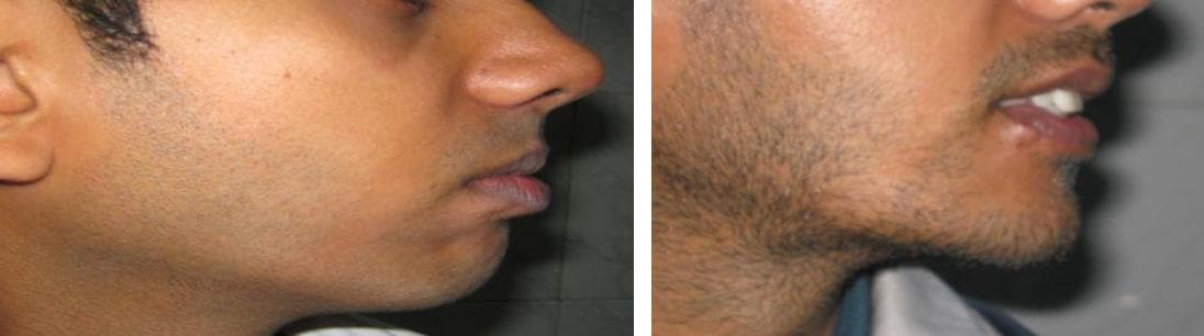 nose job cost