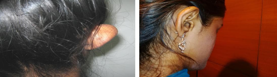 nose job cost