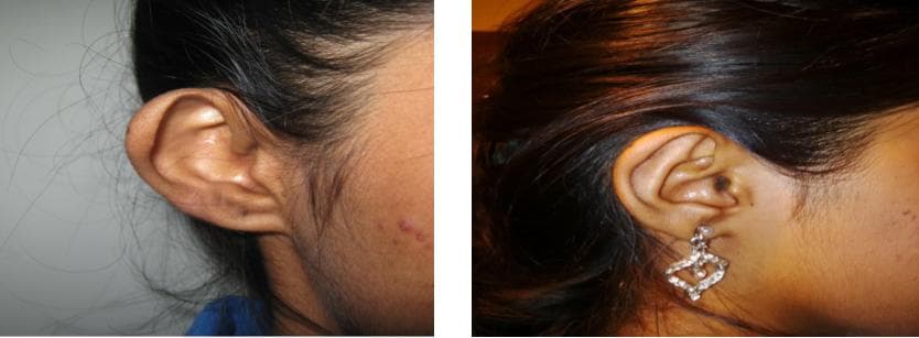 nose job cost