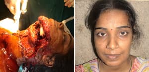 nose job cost