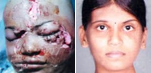 nose job cost