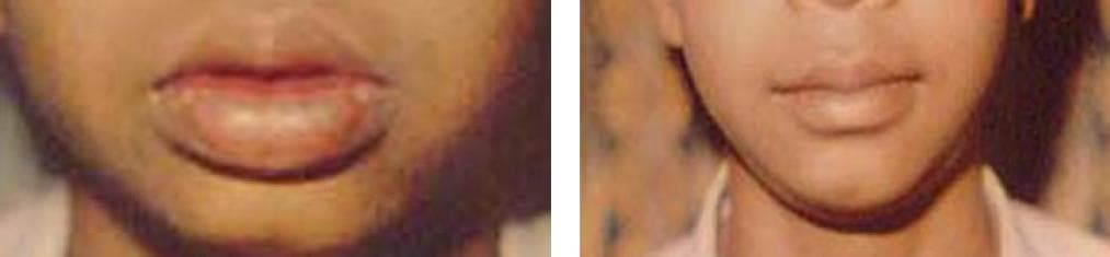 nose job cost