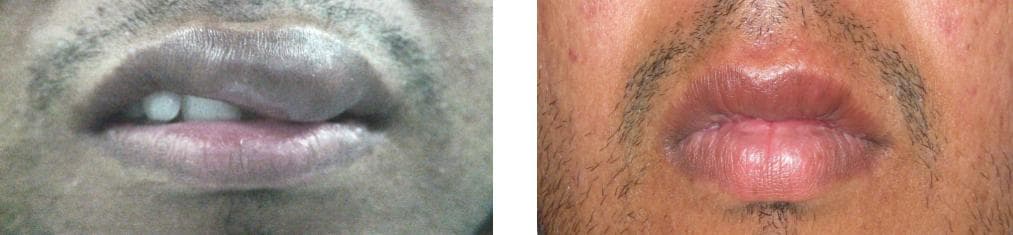 nose job cost