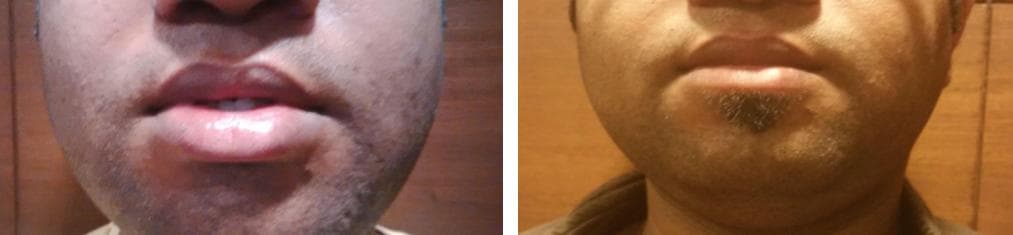 nose job cost