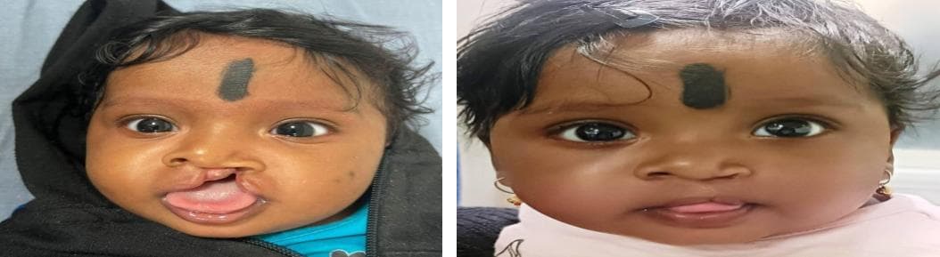 nose job cost