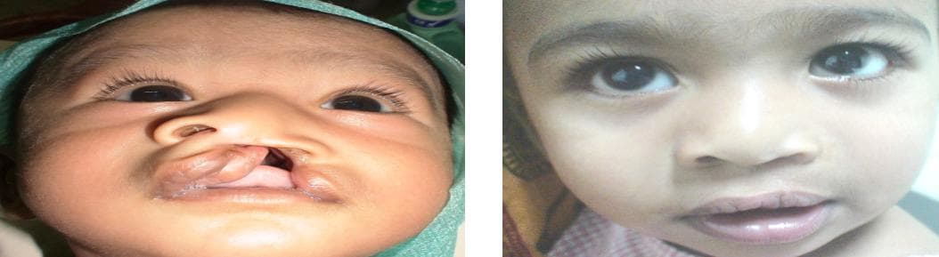 nose job cost