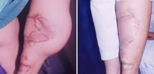 nose job cost